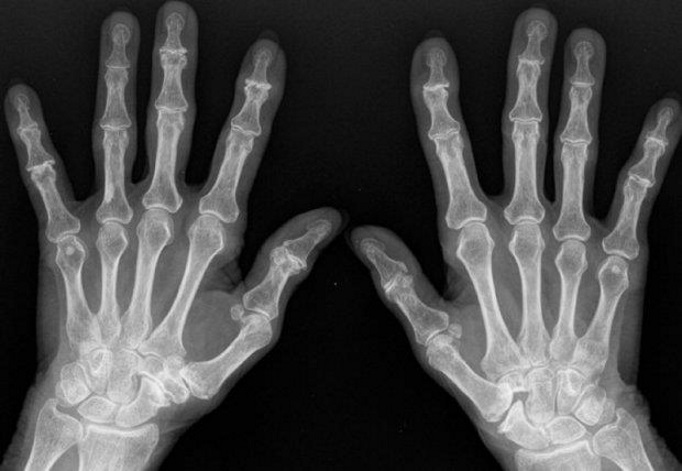 L'arthrose digitale, ses causes, ses manifestations et son traitement