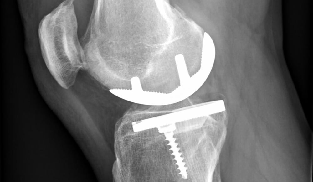 La chirurgie du genou : quand opérer, et quelle prothèse ?